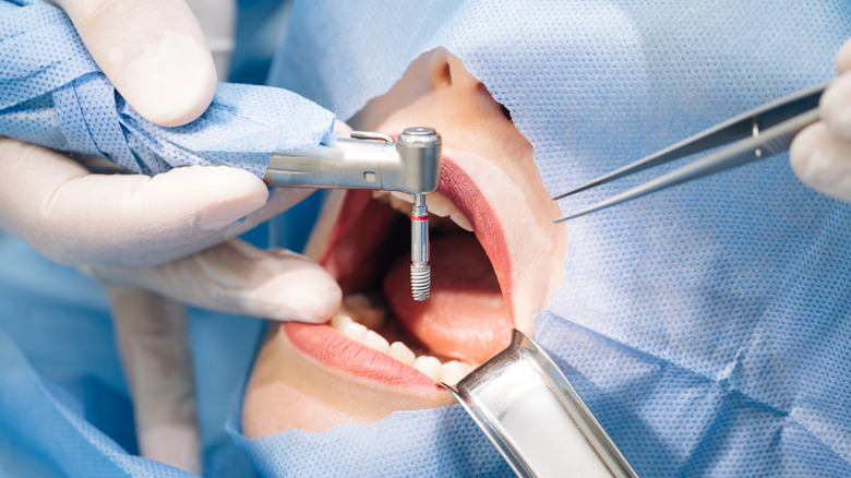 dental implant surgery