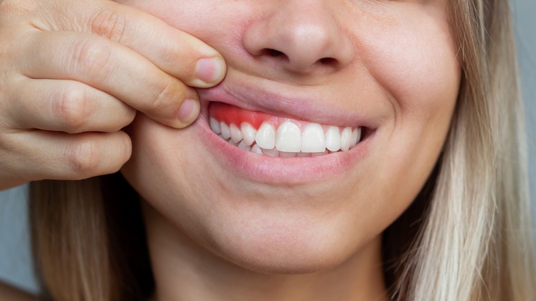 Woman with red, swollen gums