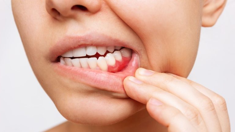 Woman with swollen gums